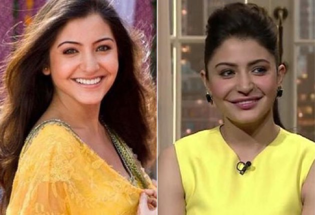 Anushka Sharma Lip Job - Before and After Surgery
